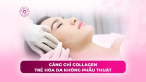 căng chỉ collagen trẻ hóa da không phẫu thuật