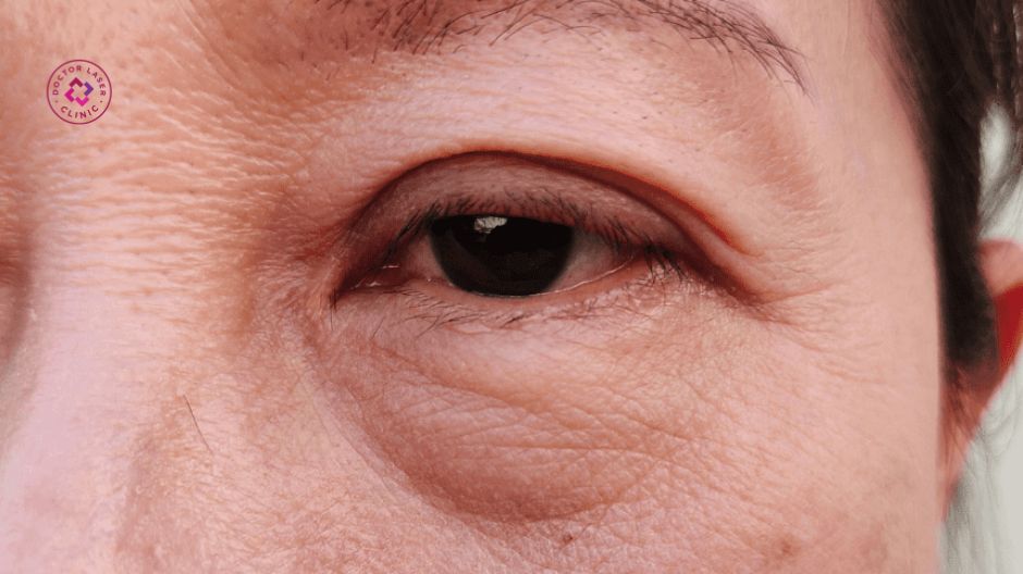 căng chỉ mắt hạn chế với sa trễ bọng mắt nặng