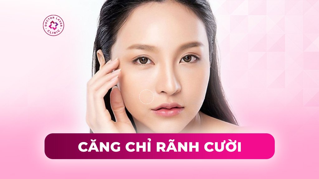 Căng chỉ rãnh cười có hiệu quả không? Có ưu nhược điểm gì?