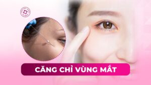 căng chỉ vùng mắt