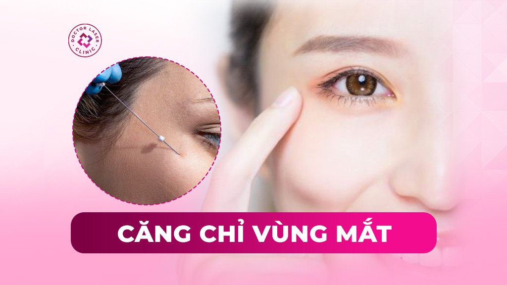Căng chỉ vùng mắt có an toàn không? Vị trí và quy trình thực hiện