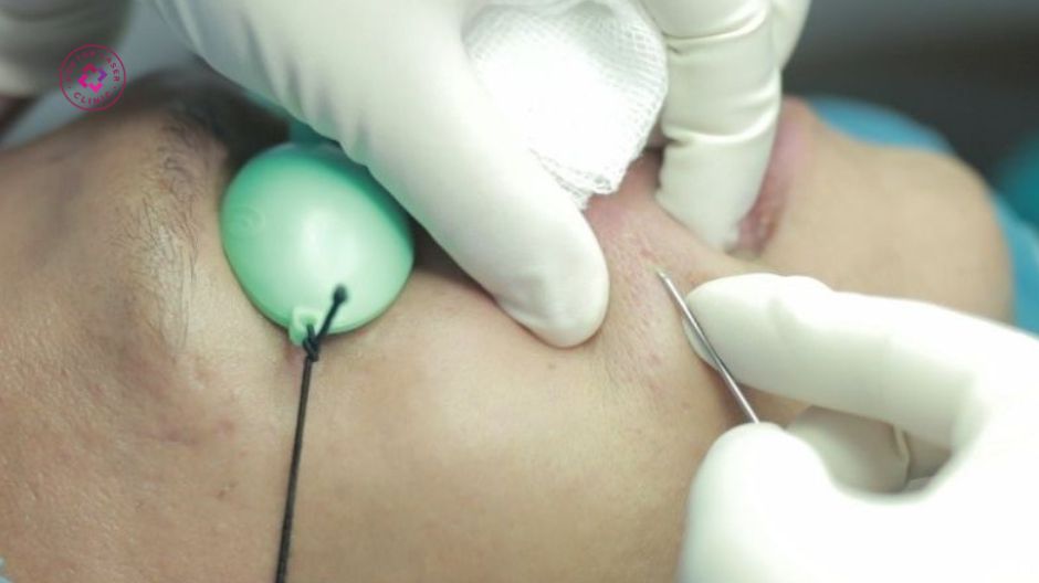 cắt đáy giải phóng chân sẹo lõm thủy đậu