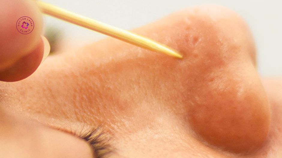 chấm tca sẹo lõm sau tẩy nốt ruồi