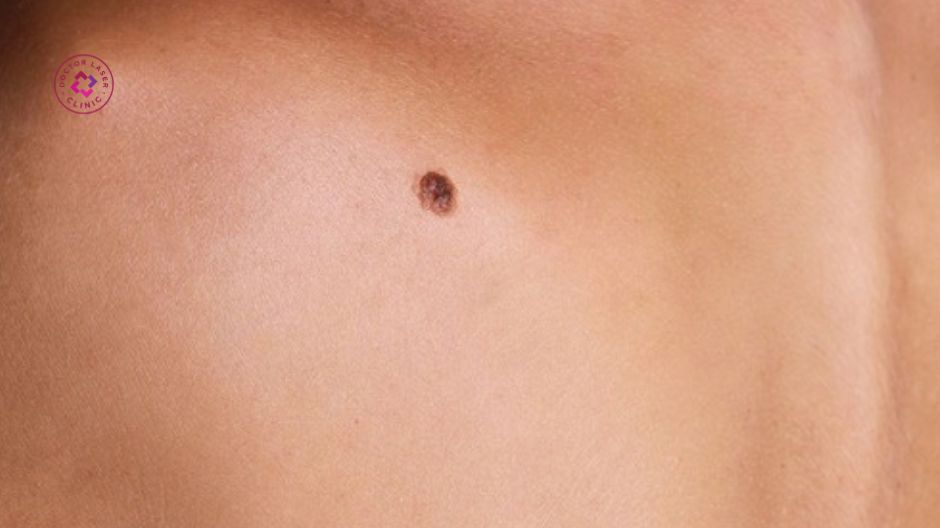 chân nốt ruồi ăn sâu gây sẹo lõm sau tẩy nốt ruồi