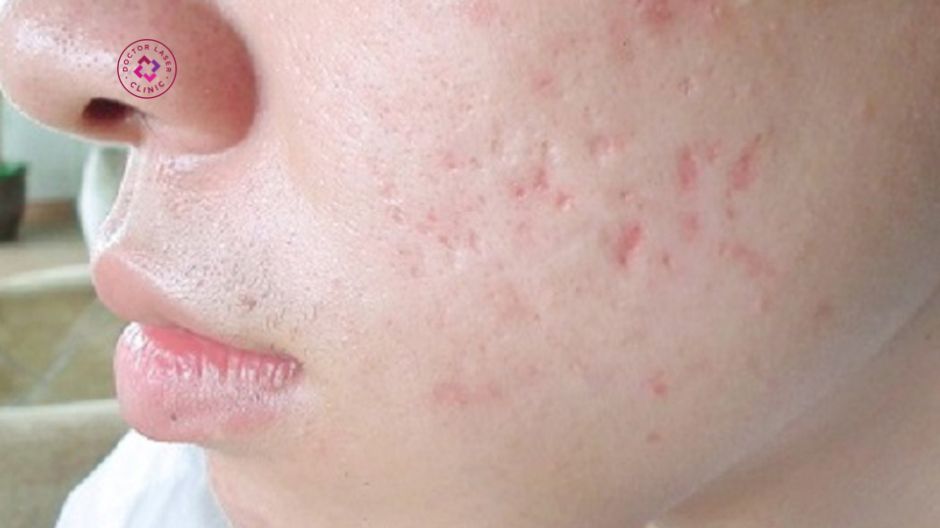 chỉ định laser co2 fractional trị sẹo rỗ