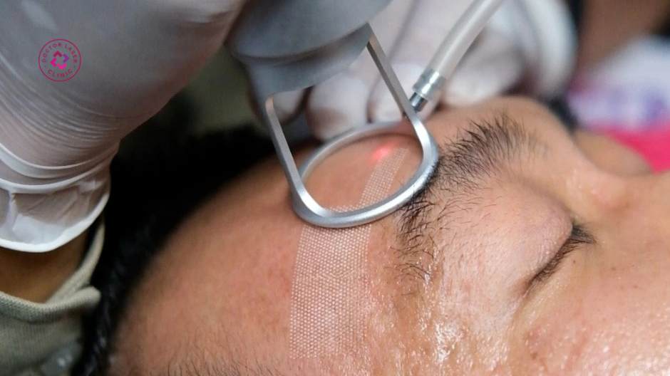 công nghệ điều trị sẹo rỗ hiện đại