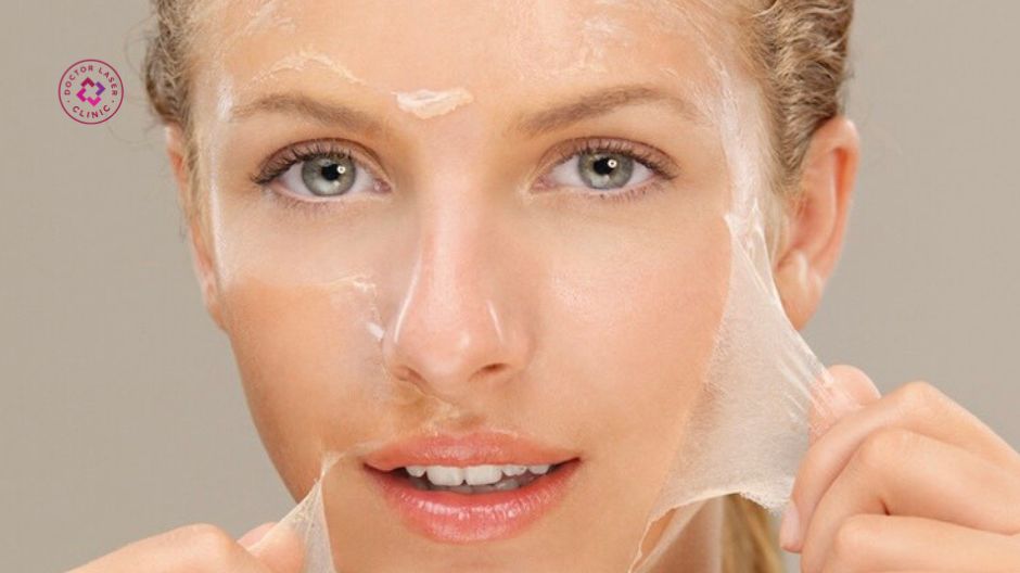 da bong sau peel trị sẹo rỗ quá trình phục hồi