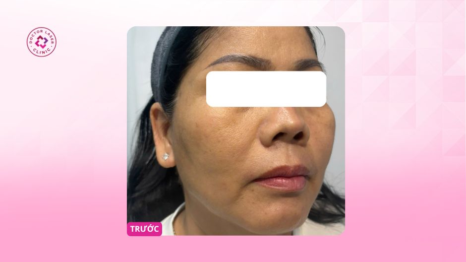 da mỏng đỏ giãn mao mạch trước điều trị