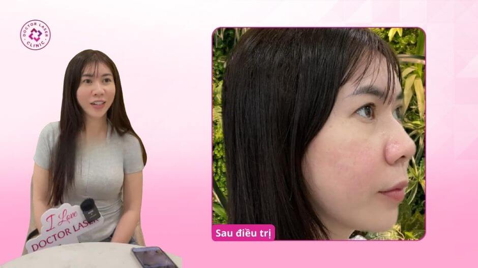 da vùng má sau điều trị sẹo rỗ