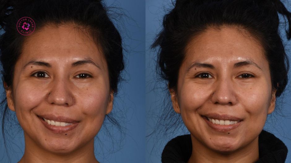 dấu hiệu rãnh cười bị đơ rõ rệt sau tiêm filler