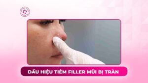 dấu hiệu tiêm filler mũi bị tràn dấu hiệu tiêm filler mũi bị tràn