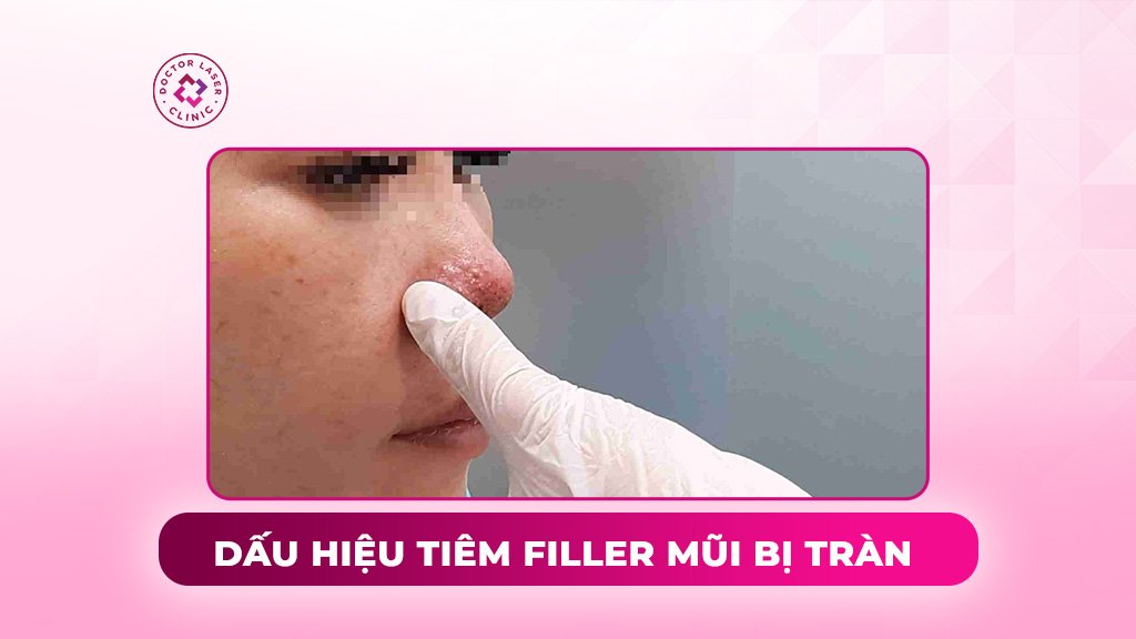 dấu hiệu tiêm filler mũi bị tràn