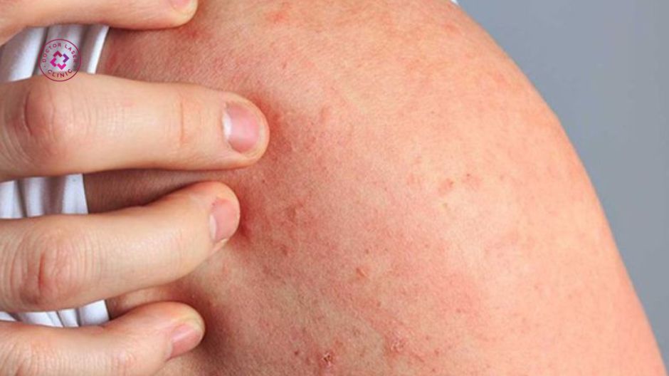 dị ứng chỉ sinh học khi nâng mũi bằng chỉ