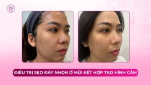 điều trị sẹo đáy nhọn ở mũi kết hợp tạo hình cằm