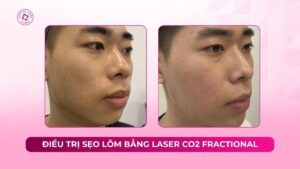cải thiện thành công sẹo lõm lâu năm bằng phương pháp laser co2