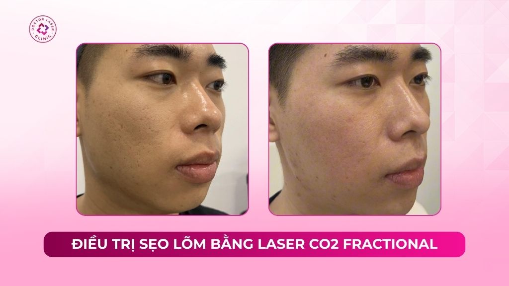 Cải thiện thành công sẹo lõm lâu năm bằng phương pháp laser CO2