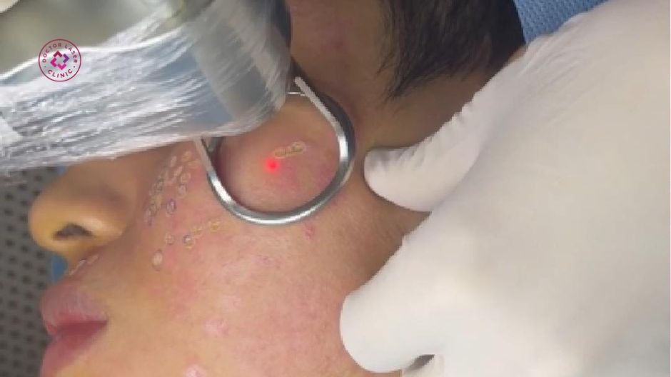 điều trị sẹo lõm bằng laser co2 quá trình thực hiện