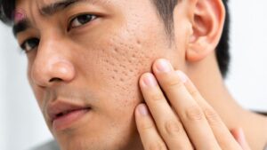 điều trị sẹo rỗ có cần làm nhiều phương pháp kết hợp không