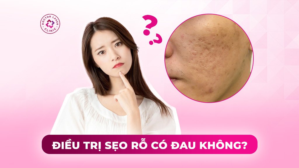 Điều trị sẹo rỗ có đau không? Các mẹo hỗ trợ giảm đau