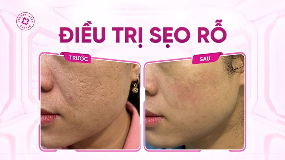 điều trị sẹo rỗ đa phương thức tại doctor laser