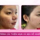 Hành trình cải thiện mụn và sẹo rỗ kéo dài nhiều năm