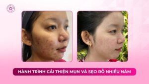 hành trình cải thiện mụn và sẹo rỗ nhiều năm