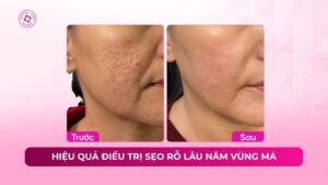 hiệu quả điều trị sẹo rỗ lâu năm vùng má