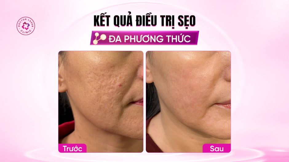 kết quả điều trị sẹo đa phương thức
