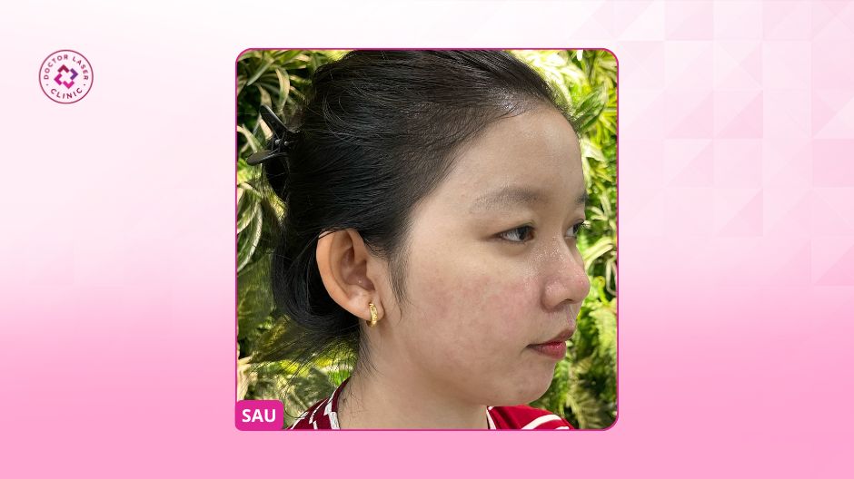 kết quả mụn và sẹo rỗ sau liệu trình điều trị