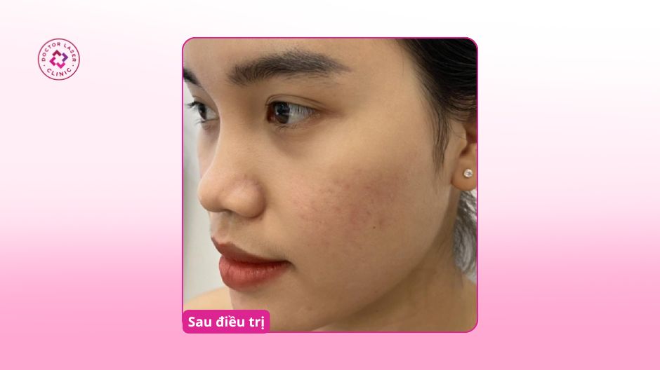 kết quả sau điều trị sẹo rỗ tại doctor laser