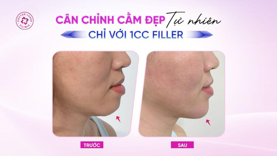 kết quả tiêm filler cằm trước và sau