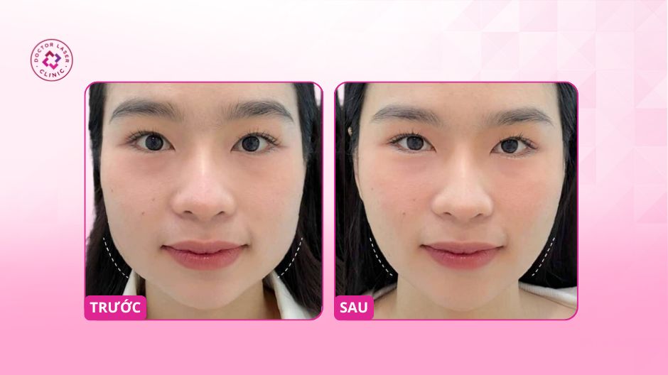 kết quả trước sau tiêm botox gọn hàm