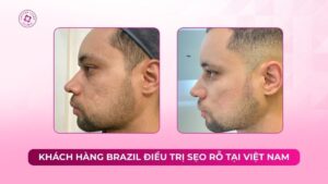 khách hàng brazil điều trị sẹo rỗ tại việt nam
