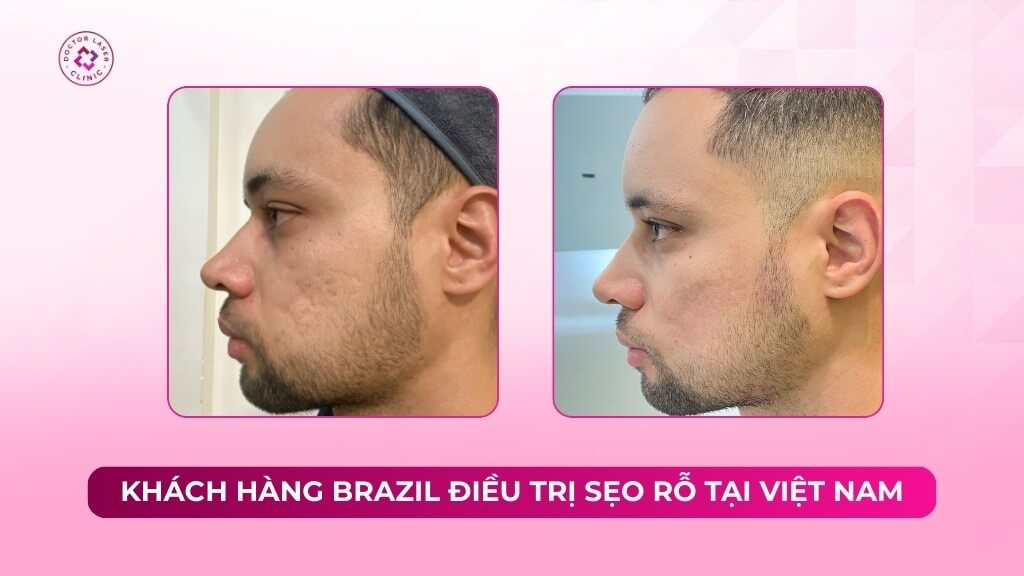 Khách hàng Brazil điều trị sẹo rỗ tại Việt Nam