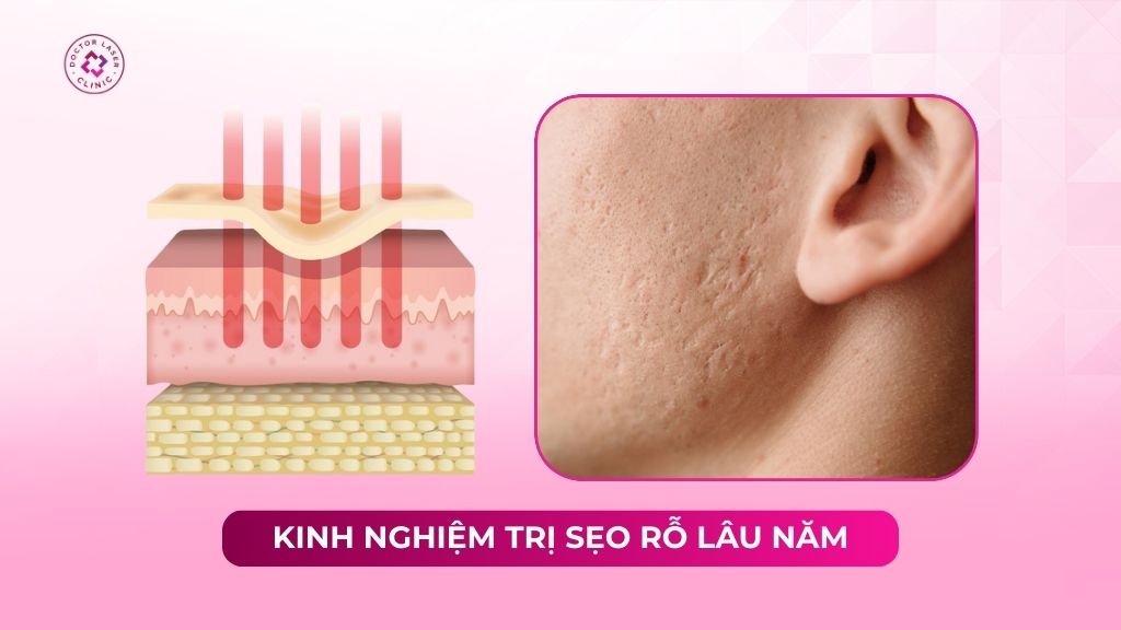 kinh nghiệm trị sẹo rỗ lâu năm