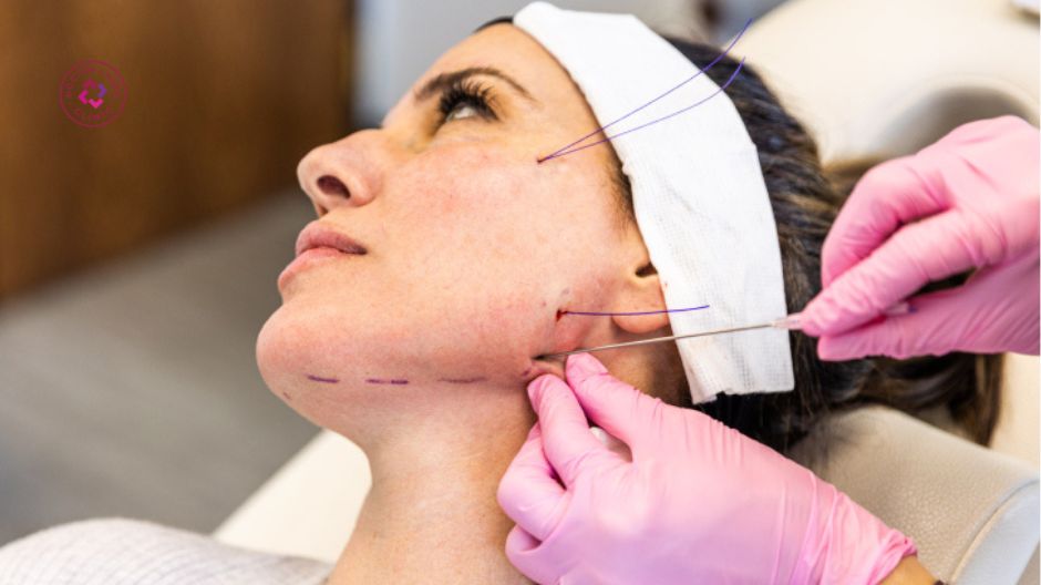 kỹ thuật của bác sĩ ảnh hưởng hiệu quả căng chỉ