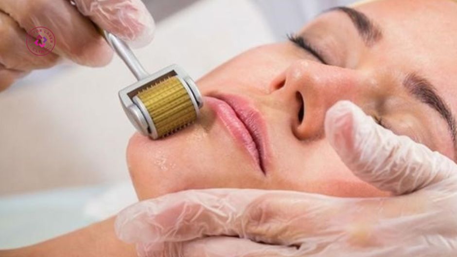 lăn kim tạo vi tổn thương kích thích collagen sẹo lõm