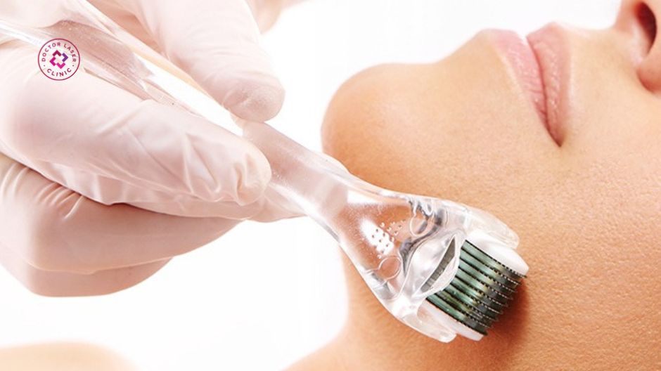 lăn kim tạo vi tổn thương kích thích collagen