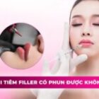 Môi tiêm filler có phun được không? Thời gian giãn cách an toàn