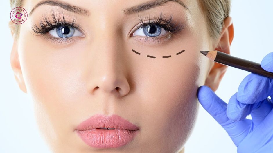 mức độ an toàn của căng chỉ vùng mắt