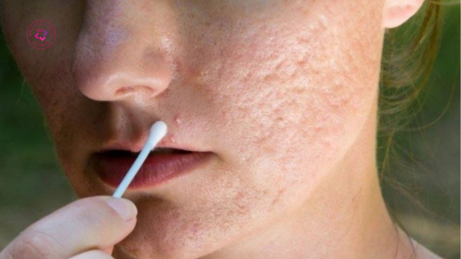 mụn viêm mụn bọc nguyên nhân gây sẹo rỗ