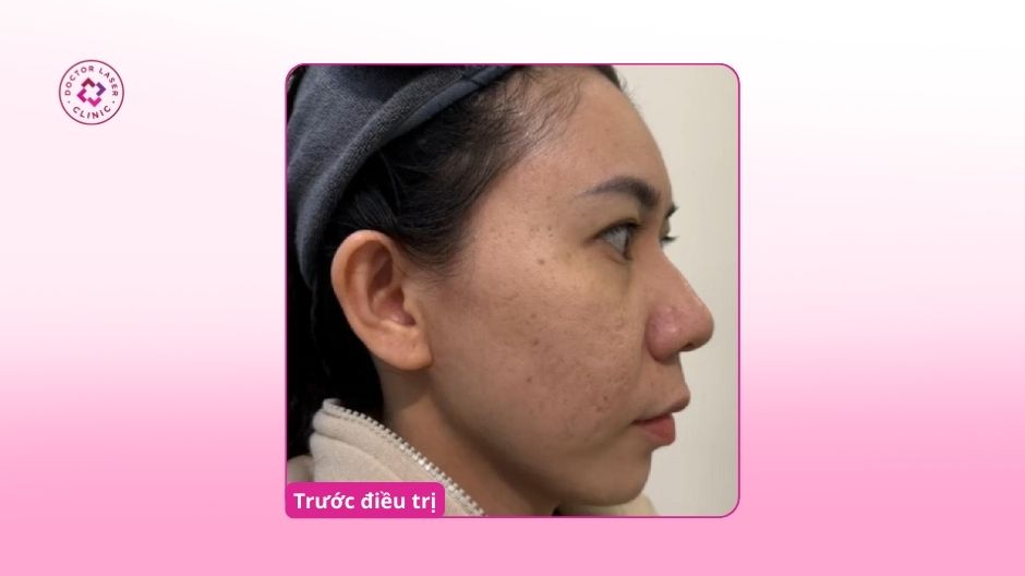 nặn mụn để lại sẹo rỗ vùng má