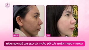 nặn mụn để lại sẹo và phác đồ y khoa