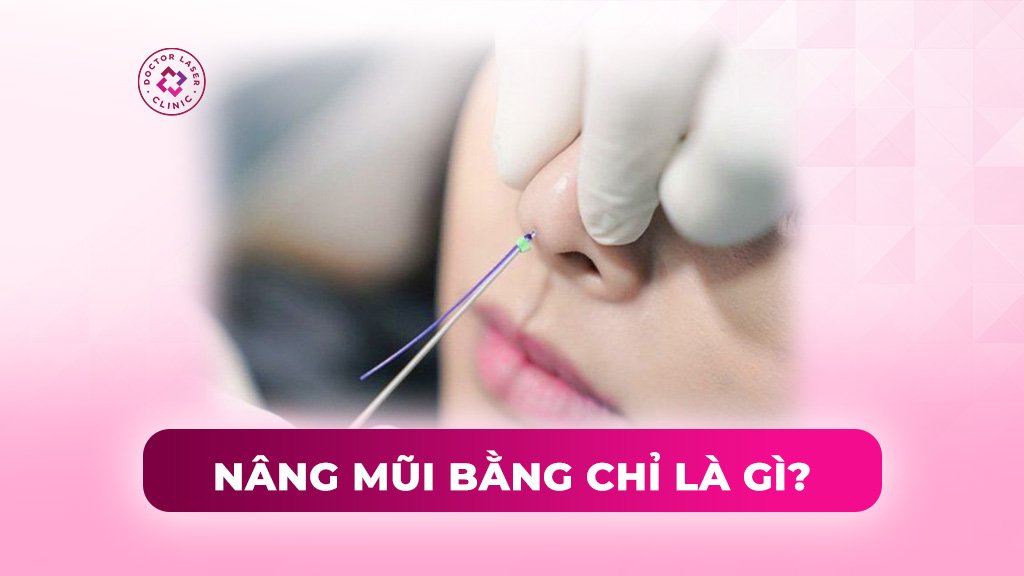 Có nên nâng mũi bằng chỉ không? Thời gian duy trì bao lâu?