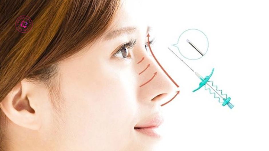 nâng mũi căng chỉ ít xâm lấn