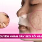 Nguyên nhân gây ra sẹo rỗ nặng, tác hại và cách điều trị