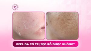 peel da trị sẹo rỗ được không peel da trị sẹo rỗ được không