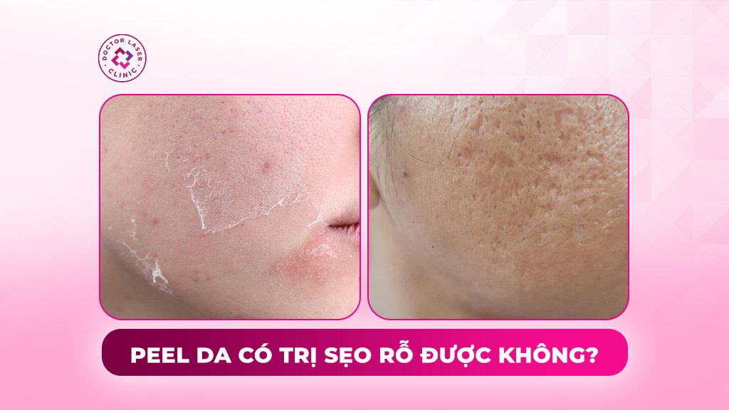 peel da trị sẹo rỗ được không