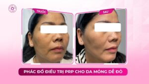 phác đồ điều trị prp cho da mỏng dễ đỏ phác đồ điều trị prp cho da mỏng dễ đỏ
