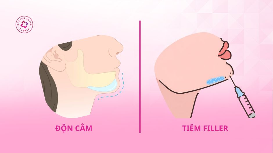 phân biệt độn cằm và filler cằm